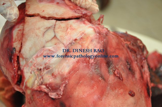 Intersecting fracture-speaks the obvious